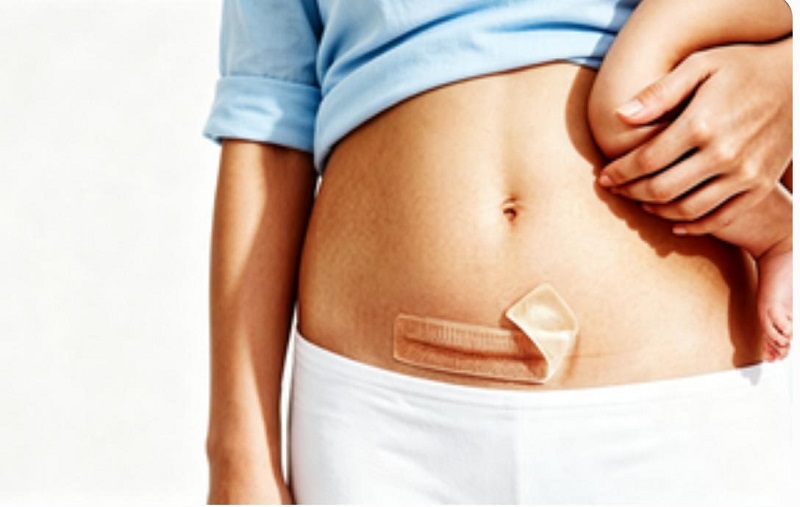Tutum Hormone-Free CmallBio Silicone cicatrix Patch in Cesarea Sectione Scari
