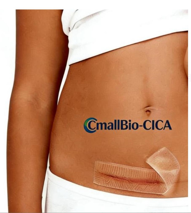 What Scar Patch Is Best for C-Section Hypertrophic Scars? A 2026 Medica-Grade Scari Patch Buying Guide